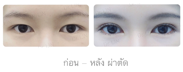 ลักษณะตาสวย_แก้หางตาตก_inzclinic