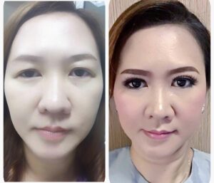 ตาปรือ กล้ามเนื้ออ่อนแรง