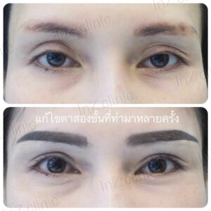 ตาปรือ กล้ามเนื้ออ่อนแรง