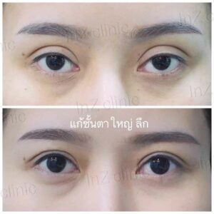 ตาปรือ กล้ามเนื้ออ่อนแรง