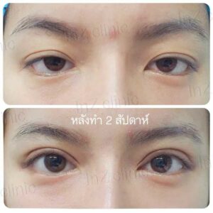 ตาปรือ กล้ามเนื้ออ่อนแรง
