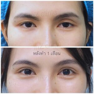 ตาปรือ กล้ามเนื้ออ่อนแรง