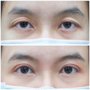 ก่อนหลัง-ทำตาสองชั้น แก้ไขตาปรือกล้ามเนื้อตาอ่อนแรง-หมอหลิน-91