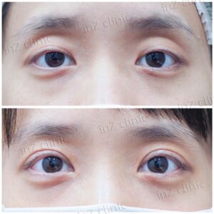 ก่อนหลัง-ทำตาสองชั้น แก้ไขตาปรือกล้ามเนื้อตาอ่อนแรง-หมอหลิน-94