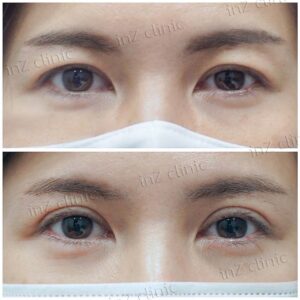 ก่อนหลัง-ทำตาสองชั้น แก้ไขตาปรือกล้ามเนื้อตาอ่อนแรง-หมอหลิน-95