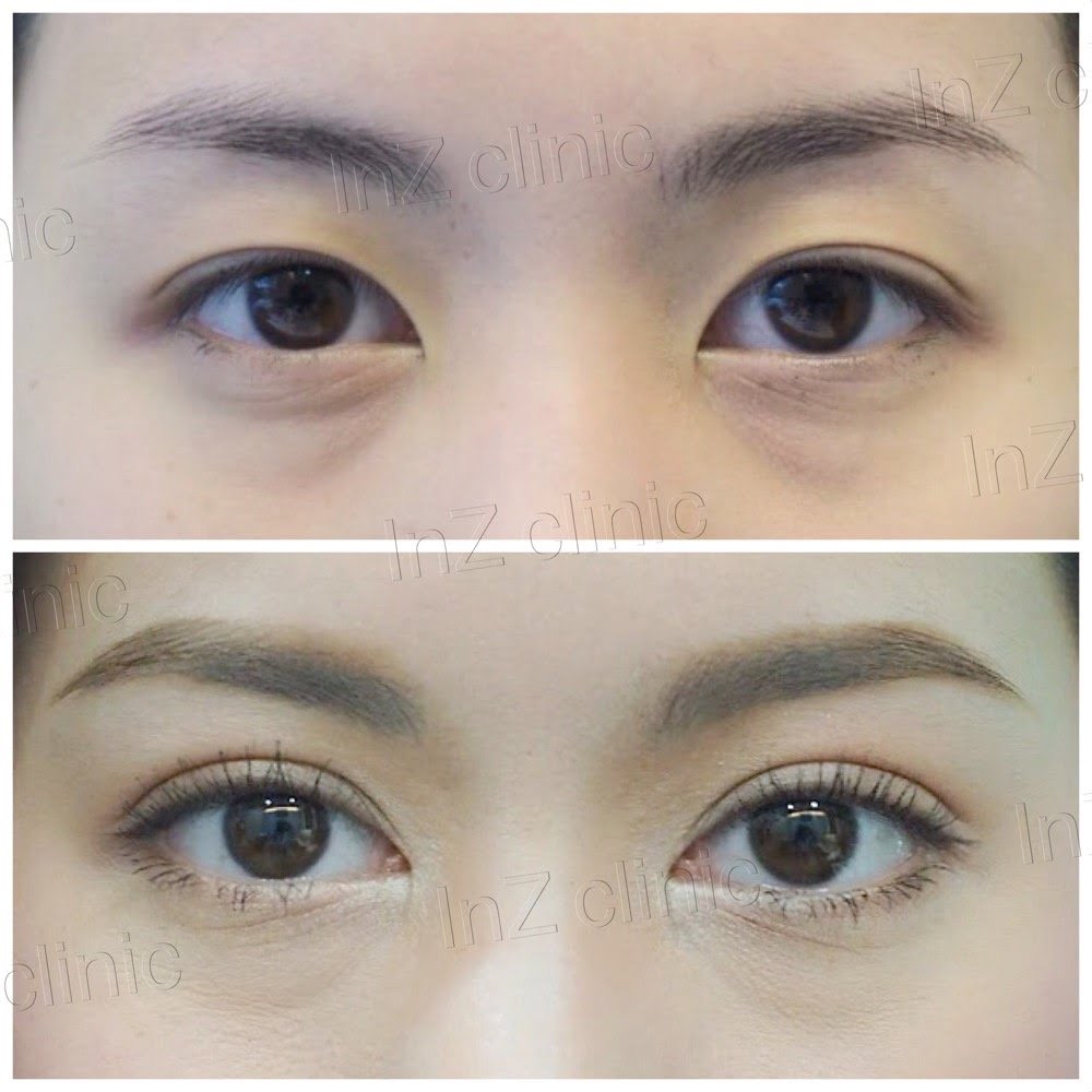 การทำตาสองชั้น ข้อดี ข้อเสีย ในปัจจุบัน_04