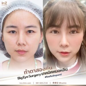 ตาสองชั้นทีมจักษุแพทย์