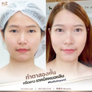ตาสองชั้นทีมจักษุแพทย์