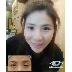 ตาไม่เท่ากัน