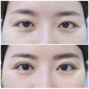 ตาไม่เท่ากัน