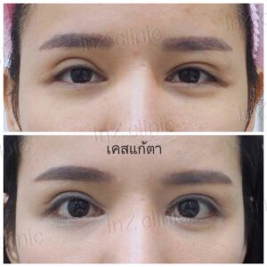 ตาไม่เท่ากัน