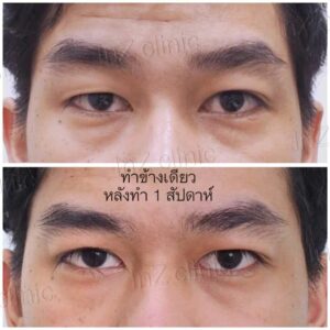 ตาไม่เท่ากัน