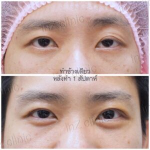 ตาไม่เท่ากัน