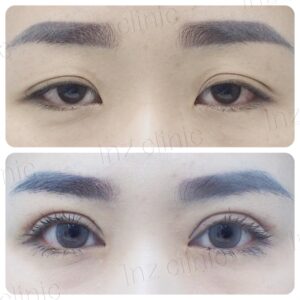 ตาไม่เท่ากัน