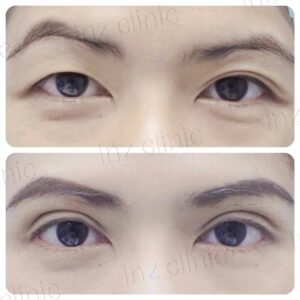 ตาไม่เท่ากัน