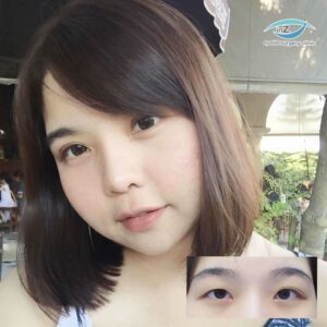 ตาไม่เท่ากัน