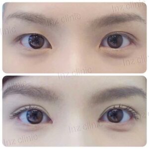ตาไม่เท่ากัน