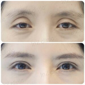ตาไม่เท่ากัน