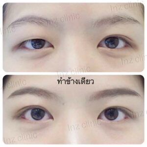 ตาไม่เท่ากัน