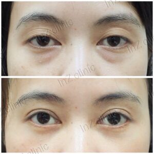 ถุงใต้ตา