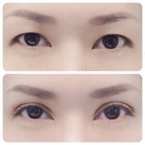 ตาสองชั้นกรีดยาว เก็บหนังตาส่วนเกิน