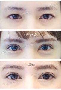 ตาสองชั้นกรีดยาว เก็บหนังตาส่วนเกิน