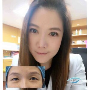 ตาสองชั้นกรีดยาว เก็บหนังตาส่วนเกิน