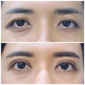 ตาสองชั้นกรีดยาว เก็บหนังตาส่วนเกิน