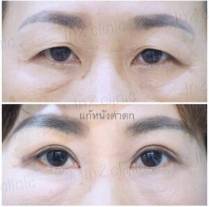 ตาสองชั้นกรีดยาว เก็บหนังตาส่วนเกิน
