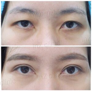 ตาสองชั้นกรีดยาว เก็บหนังตาส่วนเกิน