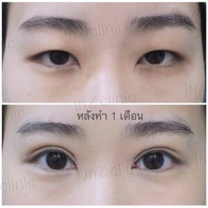 ตาสองชั้นกรีดยาว เก็บหนังตาส่วนเกิน