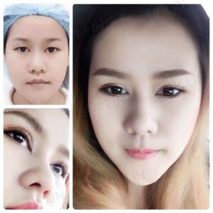 ตาสองชั้นกรีดยาว เก็บหนังตาส่วนเกิน