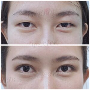 ตาสองชั้นกรีดยาว เก็บหนังตาส่วนเกิน