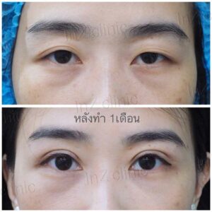 ตาสองชั้นกรีดยาว เก็บหนังตาส่วนเกิน