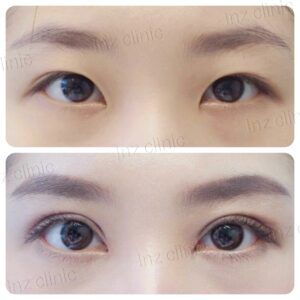 ตาสองชั้นกรีดยาว เก็บหนังตาส่วนเกิน
