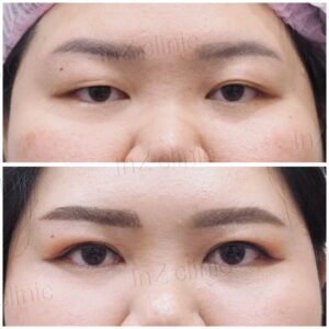 ตาสองชั้นกรีดยาว เก็บหนังตาส่วนเกิน