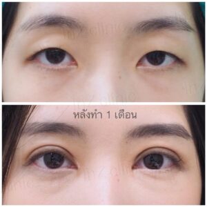 ตาสองชั้นกรีดยาว เก็บหนังตาส่วนเกิน