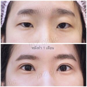 ตาสองชั้นกรีดยาว เก็บหนังตาส่วนเกิน