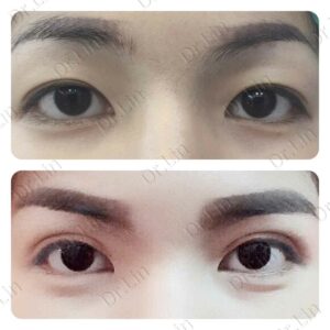 ตาสองชั้นกรีดยาว เก็บหนังตาส่วนเกิน
