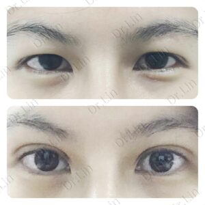 ตาสองชั้นกรีดยาว เก็บหนังตาส่วนเกิน
