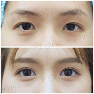ตาสองชั้นกรีดยาว เก็บหนังตาส่วนเกิน