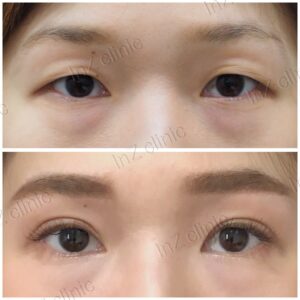 ตาสองชั้นกรีดยาว เก็บหนังตาส่วนเกิน