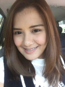 ตาสองชั้นกรีดยาว เก็บหนังตาส่วนเกิน
