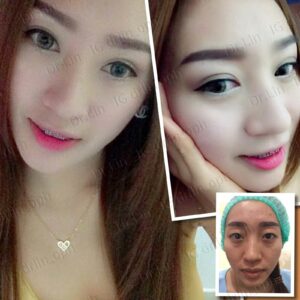 ตาสองชั้นกรีดยาว เก็บหนังตาส่วนเกิน
