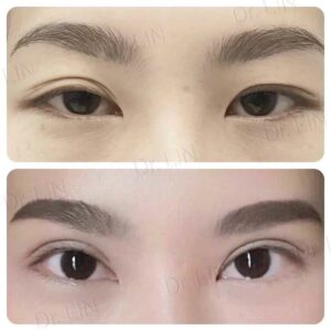 ตาสองชั้นกรีดยาว เก็บหนังตาส่วนเกิน