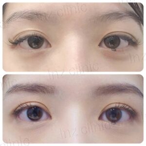 ตาสองชั้นกรีดยาว เก็บหนังตาส่วนเกิน