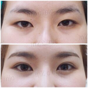 ตาชั้นเดียว