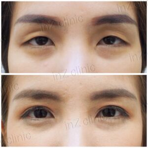 ตาชั้นเดียว