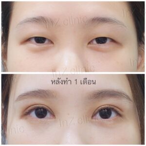 ตาชั้นเดียว