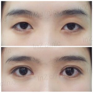 ตาชั้นเดียว